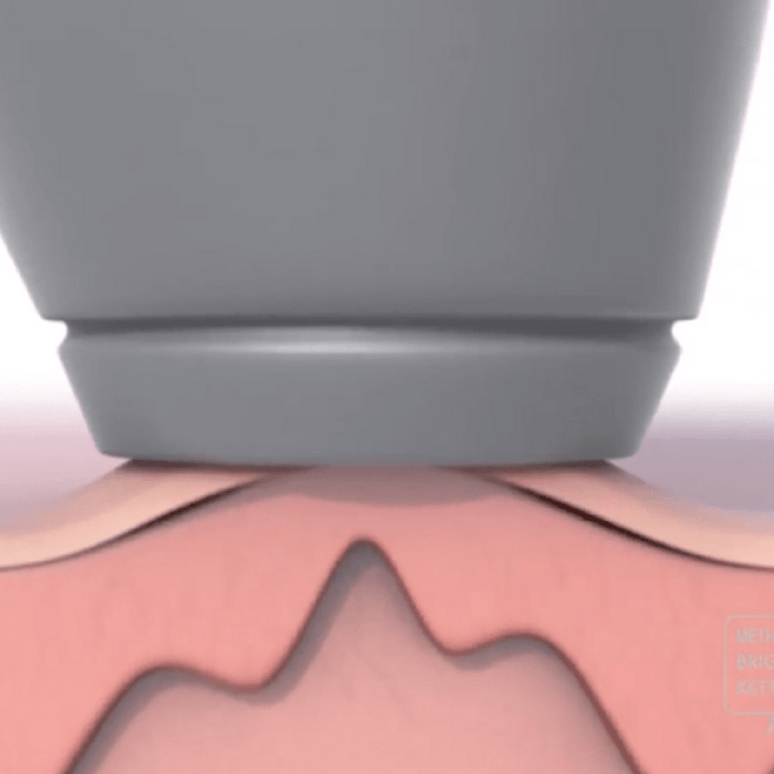DISCONTINUED - MBK Microdermabrasion | MBK Skincare