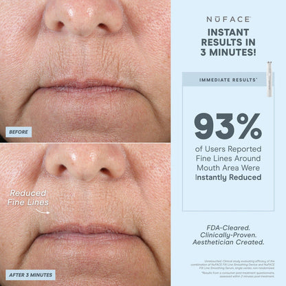 DISCONTINUED - NuFACE FIX® Starter Kit | NuFACE